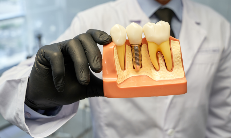 dental implants for improved oral health
