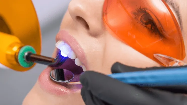 Teeth bonding procedure
