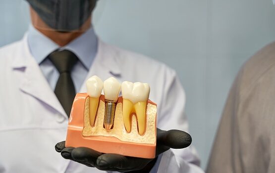 Dental Implants