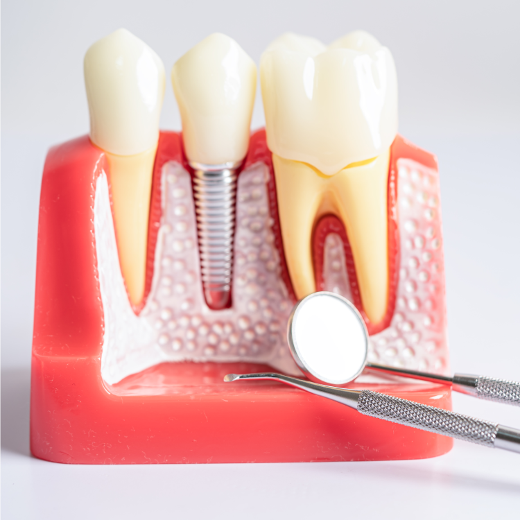 Dental Implants