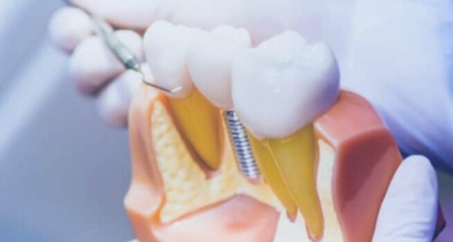 Dental Implants Treatment