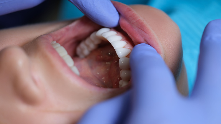 Dental Bonding Care & Longevity Guide