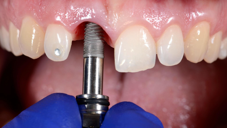 Implant Surgery